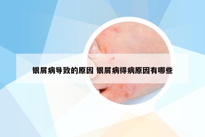 银屑病导致的原因 银屑病得病原因有哪些