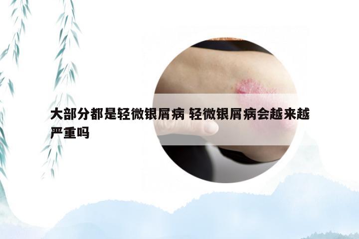 大部分都是轻微银屑病 轻微银屑病会越来越严重吗