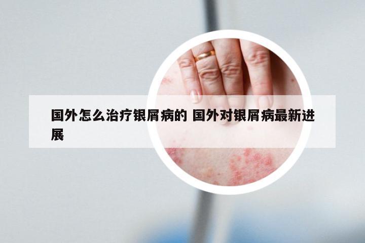 国外怎么治疗银屑病的 国外对银屑病最新进展