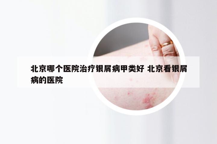 北京哪个医院治疗银屑病甲类好 北京看银屑病的医院