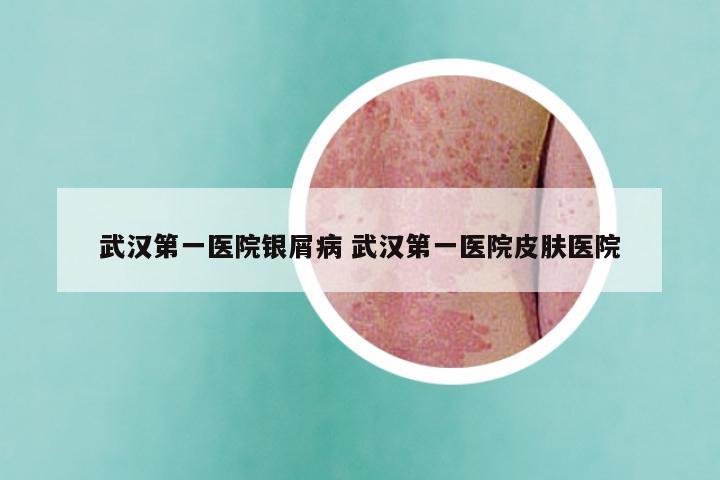武汉第一医院银屑病 武汉第一医院皮肤医院