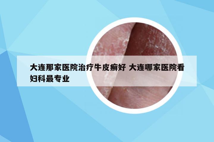 大连那家医院治疗牛皮癣好 大连哪家医院看妇科最专业