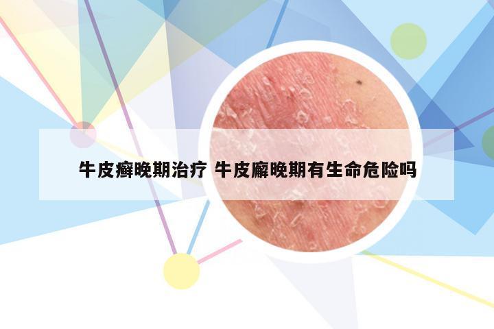 牛皮癣晚期治疗 牛皮廨晚期有生命危险吗