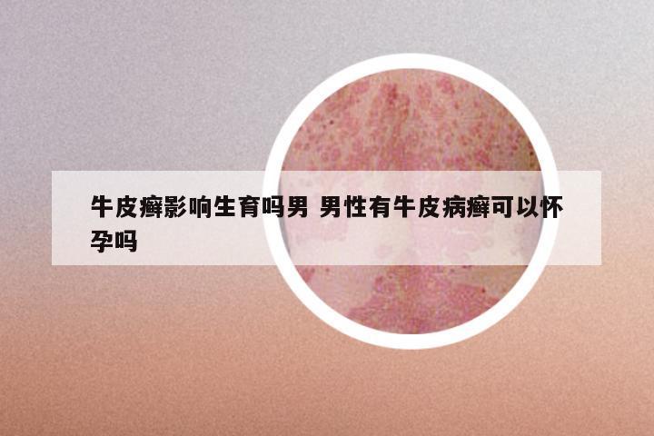 牛皮癣影响生育吗男 男性有牛皮病癣可以怀孕吗