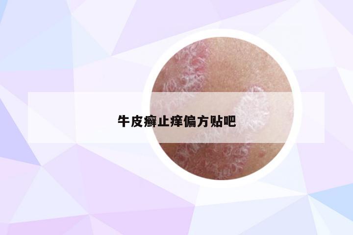 牛皮癣止痒偏方贴吧