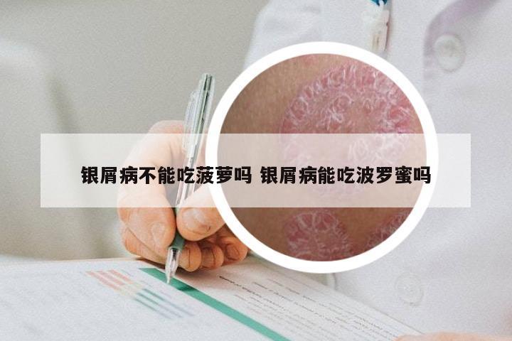 银屑病不能吃菠萝吗 银屑病能吃波罗蜜吗