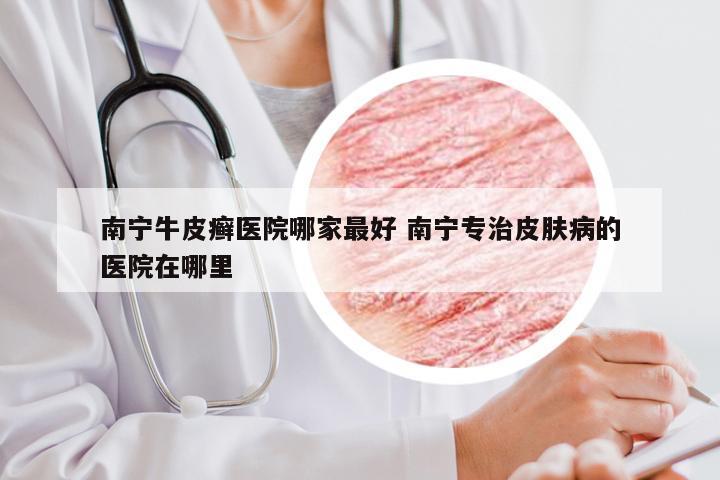 南宁牛皮癣医院哪家最好 南宁专治皮肤病的医院在哪里