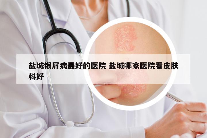 盐城银屑病最好的医院 盐城哪家医院看皮肤科好