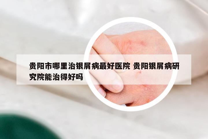 贵阳市哪里治银屑病最好医院 贵阳银屑病研究院能治得好吗
