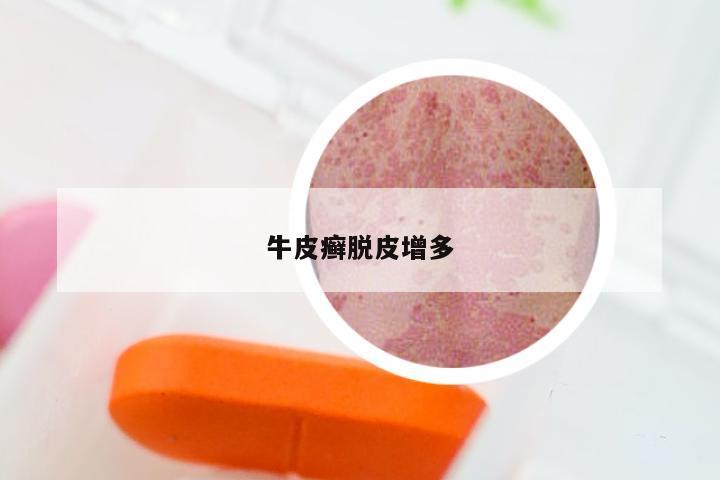 牛皮癣脱皮增多