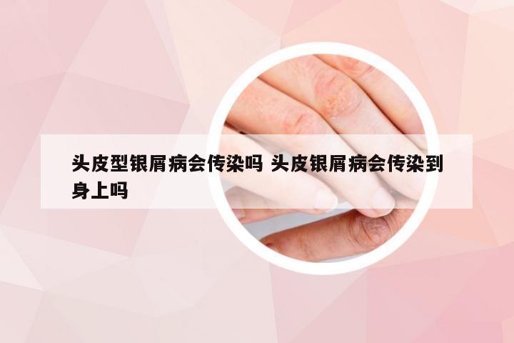 头皮型银屑病会传染吗 头皮银屑病会传染到身上吗