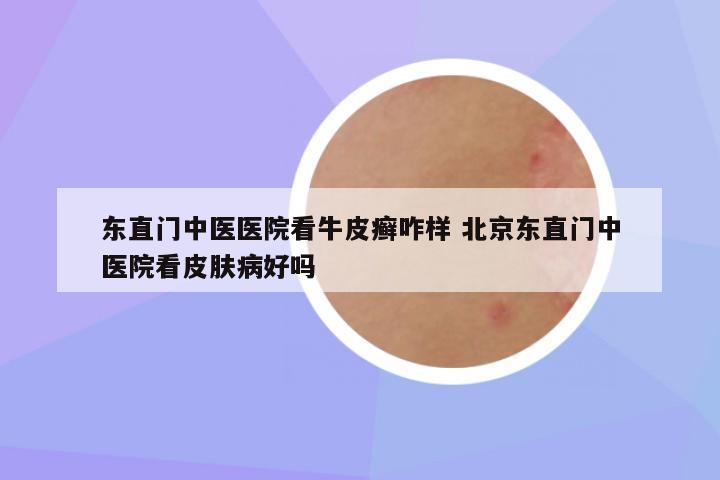 东直门中医医院看牛皮癣咋样 北京东直门中医院看皮肤病好吗