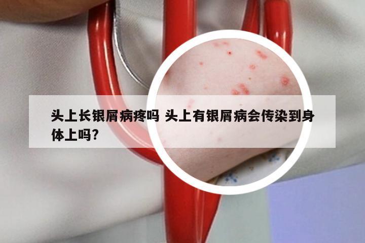 头上长银屑病疼吗 头上有银屑病会传染到身体上吗?