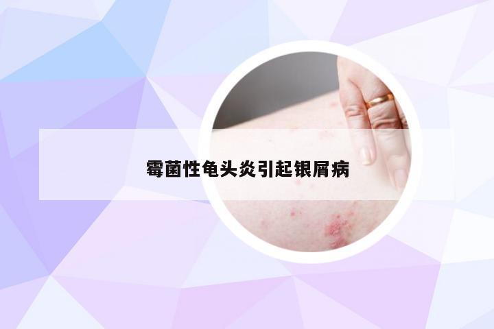 霉菌性龟头炎引起银屑病