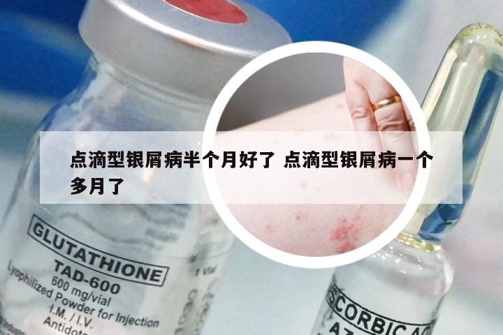 点滴型银屑病半个月好了 点滴型银屑病一个多月了