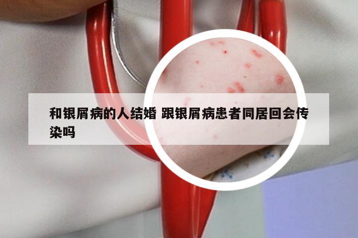 和银屑病的人结婚 跟银屑病患者同居回会传染吗