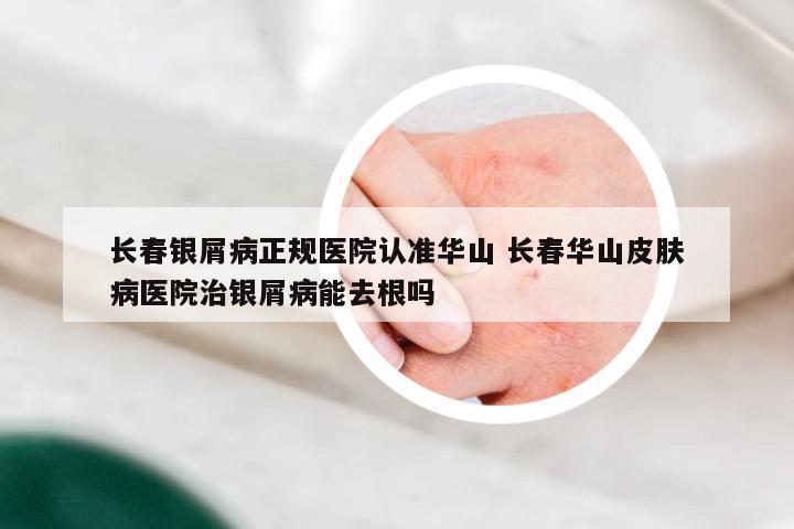 长春银屑病正规医院认准华山 长春华山皮肤病医院治银屑病能去根吗
