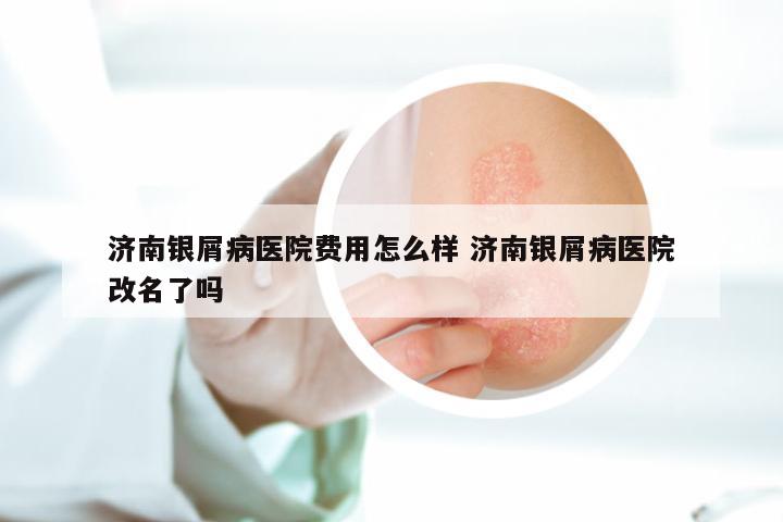济南银屑病医院费用怎么样 济南银屑病医院改名了吗