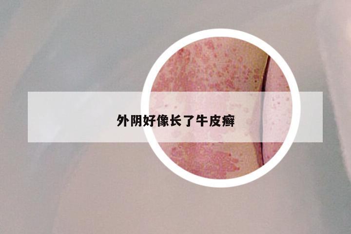 外阴好像长了牛皮癣