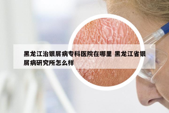 黑龙江治银屑病专科医院在哪里 黑龙江省银屑病研究所怎么样