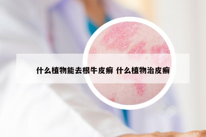 什么植物能去根牛皮癣 什么植物治皮癣