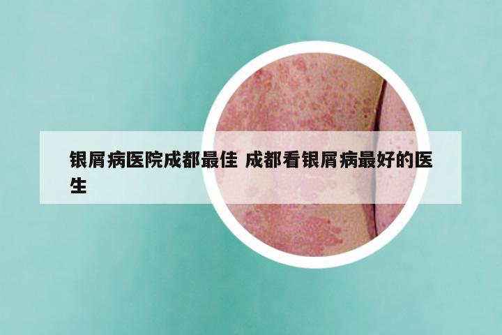 银屑病医院成都最佳 成都看银屑病最好的医生