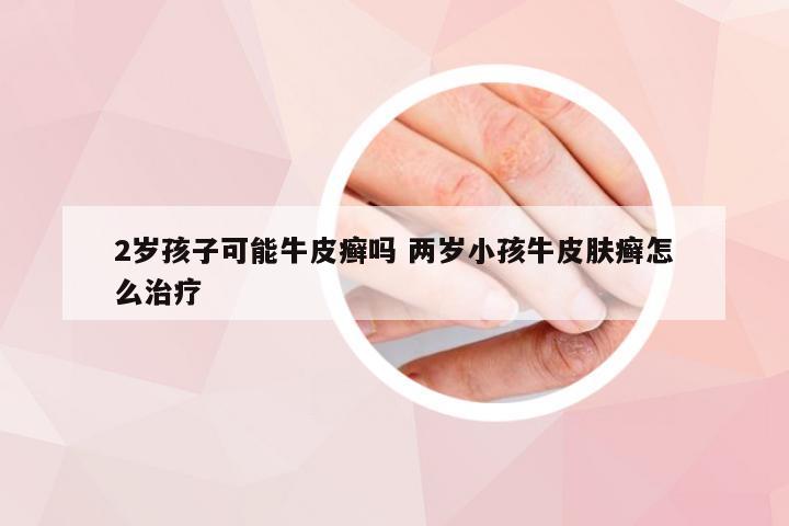 2岁孩子可能牛皮癣吗 两岁小孩牛皮肤癣怎么治疗