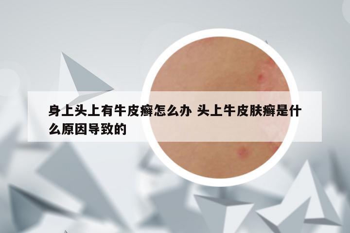 身上头上有牛皮癣怎么办 头上牛皮肤癣是什么原因导致的