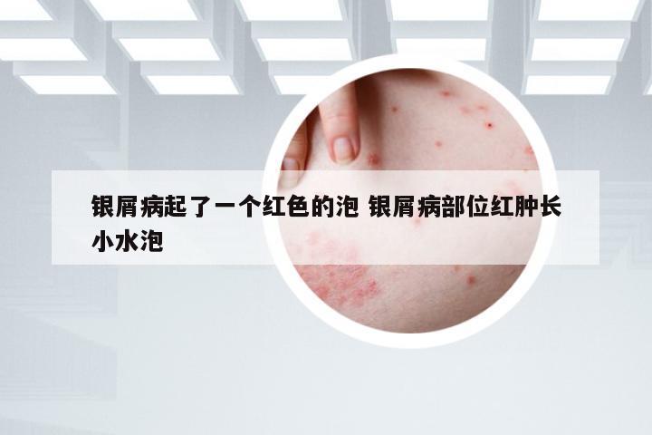 银屑病起了一个红色的泡 银屑病部位红肿长小水泡