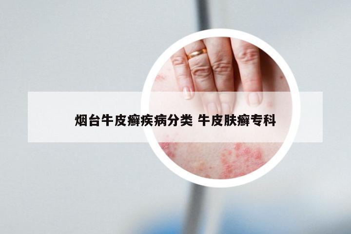 烟台牛皮癣疾病分类 牛皮肤癣专科