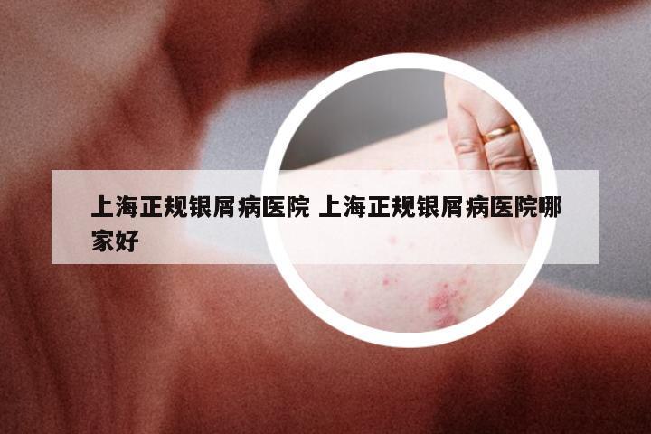 上海正规银屑病医院 上海正规银屑病医院哪家好