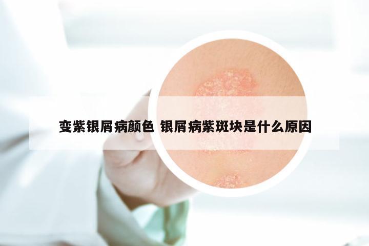 变紫银屑病颜色 银屑病紫斑块是什么原因
