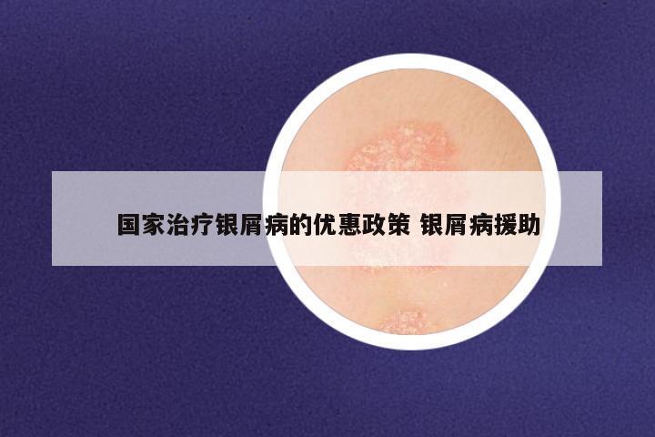 国家治疗银屑病的优惠政策 银屑病援助