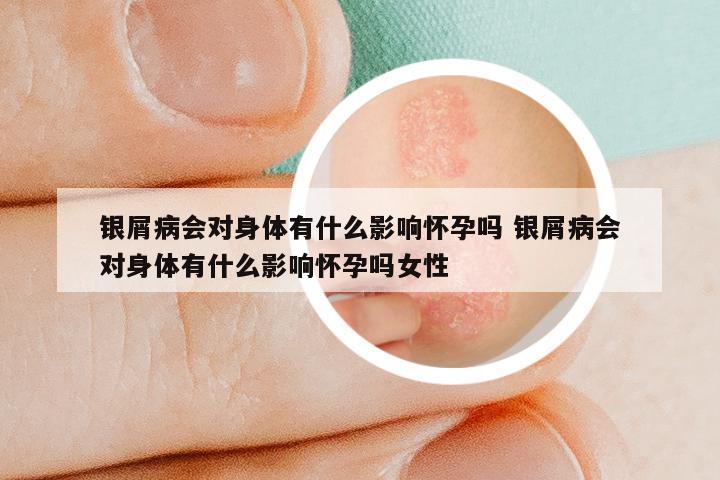 银屑病会对身体有什么影响怀孕吗 银屑病会对身体有什么影响怀孕吗女性