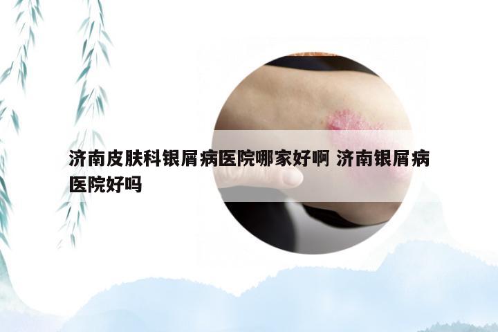 济南皮肤科银屑病医院哪家好啊 济南银屑病医院好吗
