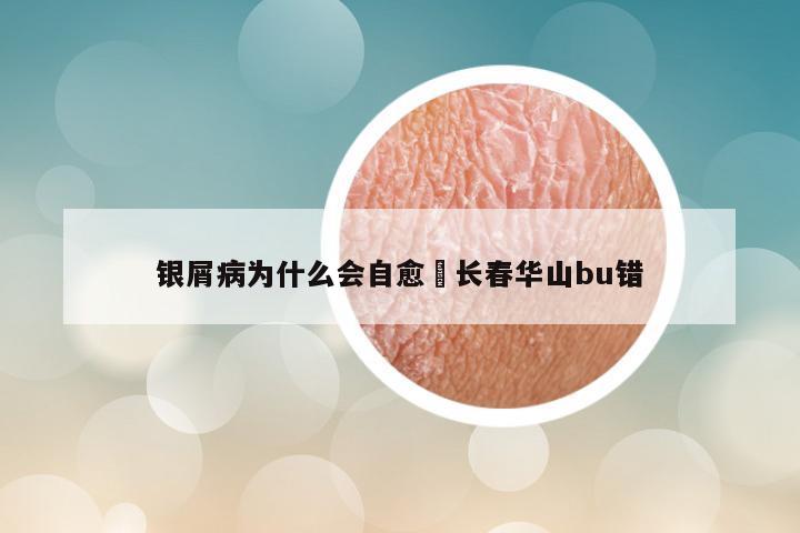 银屑病为什么会自愈來长春华山bu错
