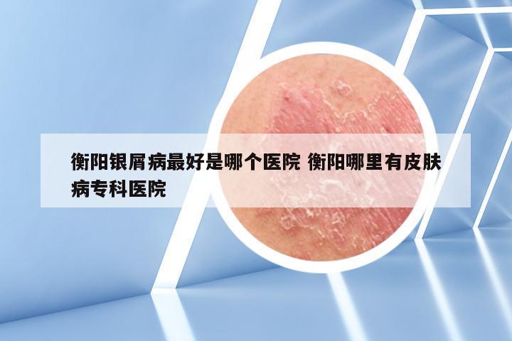 衡阳银屑病最好是哪个医院 衡阳哪里有皮肤病专科医院
