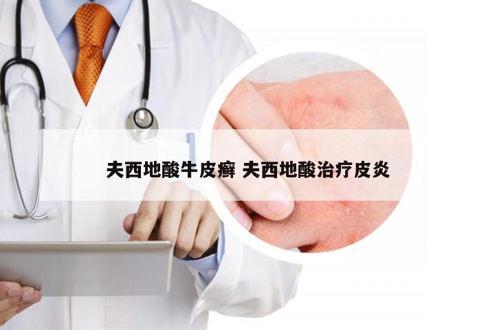 夫西地酸牛皮癣 夫西地酸治疗皮炎
