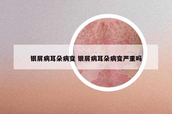 银屑病耳朵病变 银屑病耳朵病变严重吗