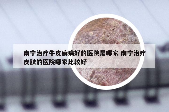 南宁治疗牛皮癣病好的医院是哪家 南宁治疗皮肤的医院哪家比较好