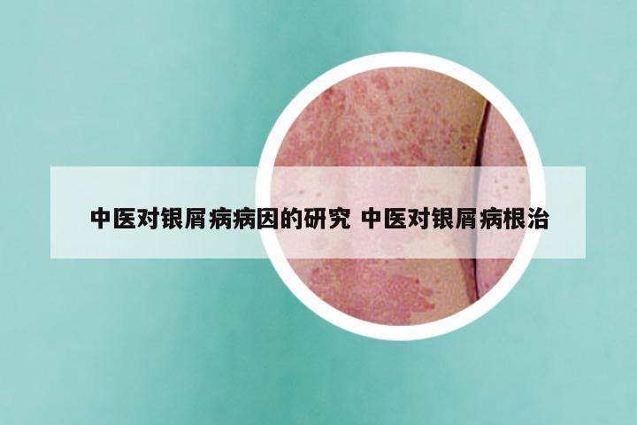 中医对银屑病病因的研究 中医对银屑病根治