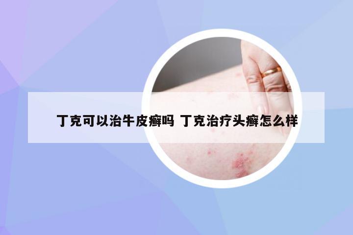 丁克可以治牛皮癣吗 丁克治疗头癣怎么样