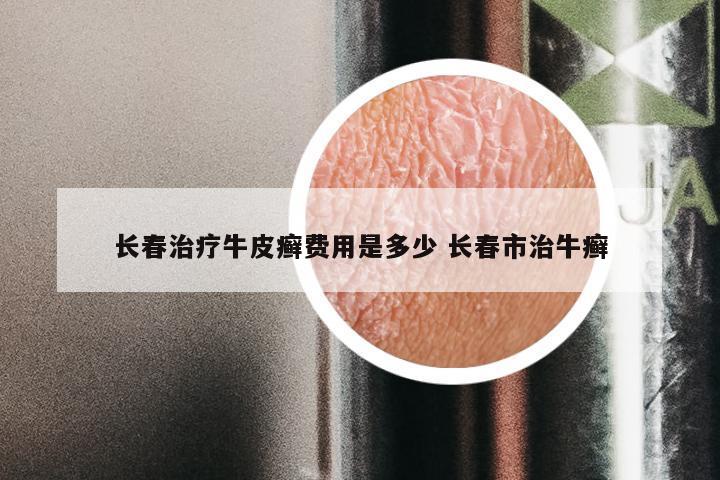 长春治疗牛皮癣费用是多少 长春市治牛癣