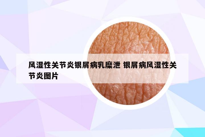 风湿性关节炎银屑病乳糜泄 银屑病风湿性关节炎图片