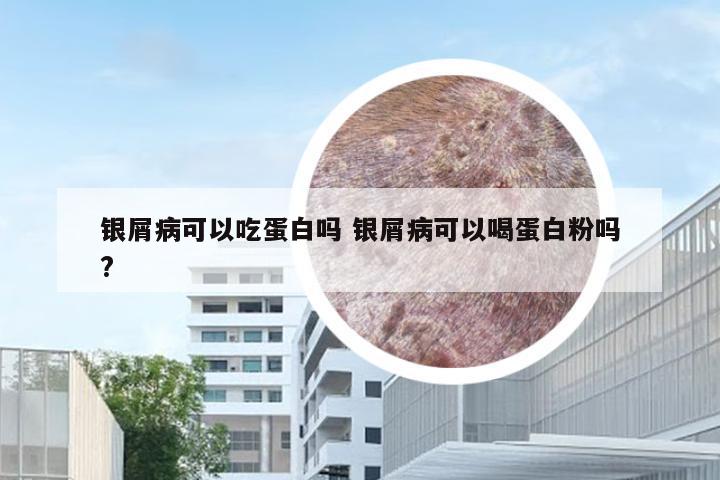 银屑病可以吃蛋白吗 银屑病可以喝蛋白粉吗?