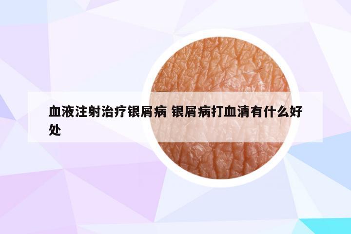 血液注射治疗银屑病 银屑病打血清有什么好处