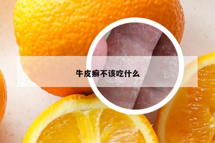 牛皮癣不该吃什么