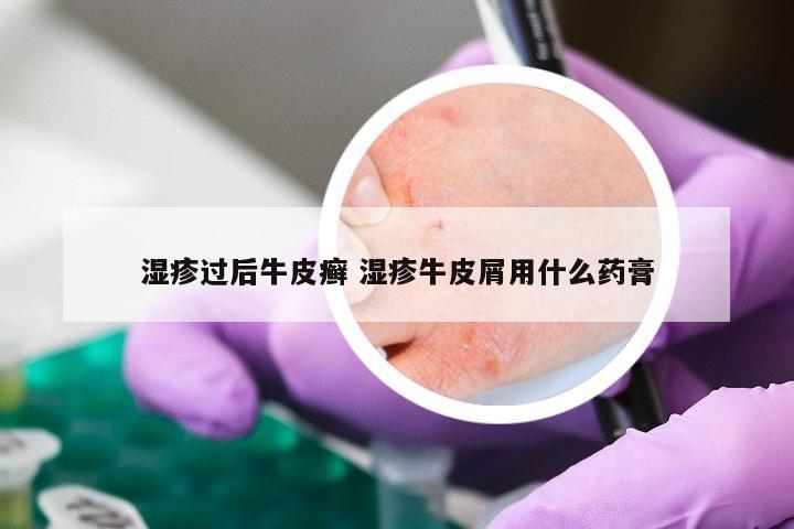 湿疹过后牛皮癣 湿疹牛皮屑用什么药膏
