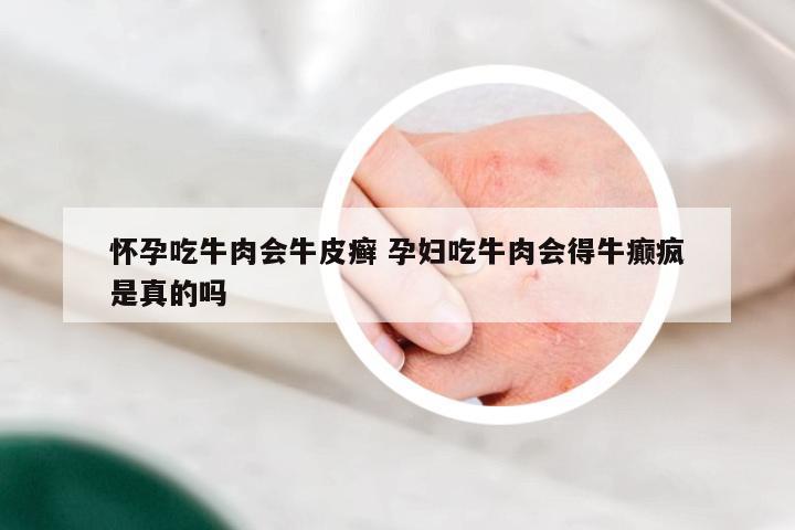 怀孕吃牛肉会牛皮癣 孕妇吃牛肉会得牛癫疯是真的吗