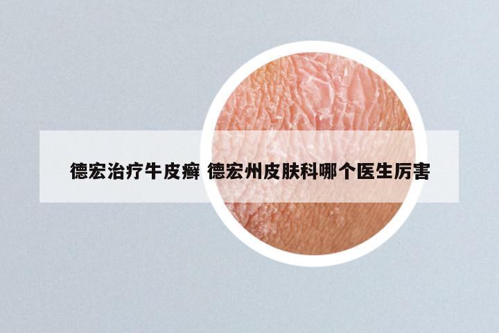 德宏治疗牛皮癣 德宏州皮肤科哪个医生厉害